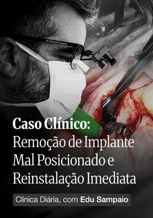 Cover for Clínica Diária, com Edu Sampaio - Caso Clínico: Remoção de Implante Mal posicionado e reinstalação imediata