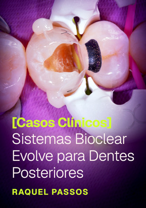 Cover for Sistemas Bioclear Evolve para dentes posteriores