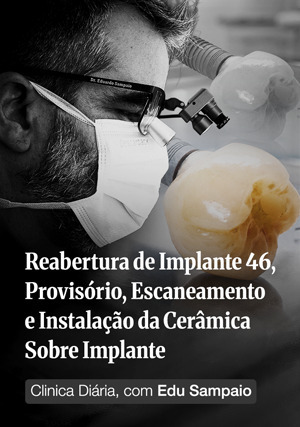 Cover for Clínica Diária, com Edu Sampaio - Reabertura de implante 46, provisório, escaneamento e instalação da cerâmica sobre Implante