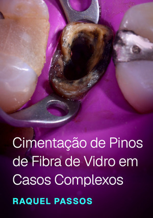 Cover for Cimentação de Pinos de Fibra de Vidro em Casos Complexos