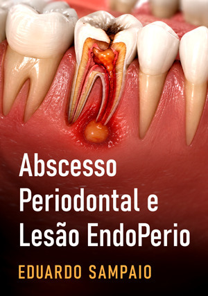 Cover for Abscesso Periodontal e Lesão EndoPerio