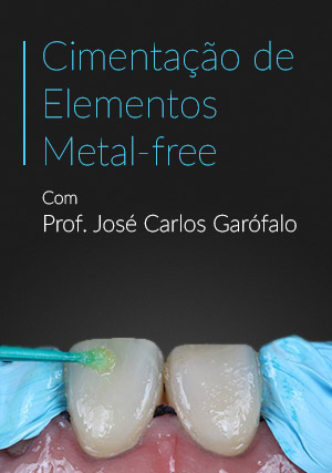 Cover for Cimentação de Elementos Metal-free: A difícil escolha do cimento e da técnica adequada