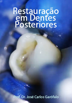 Cover for Restauração em Dentes Posteriores