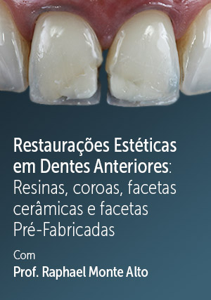 Cover for Restaurações Estéticas em Dentes Anteriores: Resinas, coroas, facetas cerâmicas e facetas Pré-Fabricadas