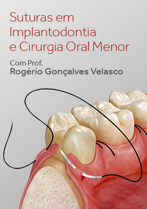 Cover for Suturas em Implantodontia e Cirurgia Oral Menor