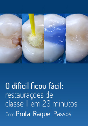 Cover for O Difícil Ficou Fácil: Restaurações de Classe II em 20 minutos