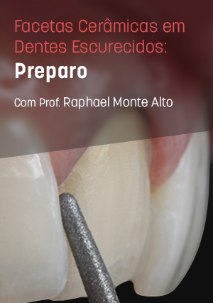 Cover for Facetas Cerâmicas em Dentes Escurecidos: Preparo