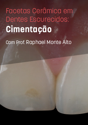 Cover for Facetas Cerâmicas em Dentes Escurecidos: Cimentação