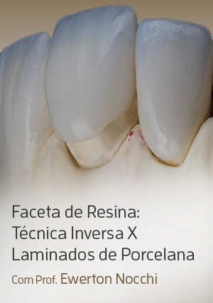 Cover for Faceta de Resina: Técnica Inversa X Laminados de Porcelana