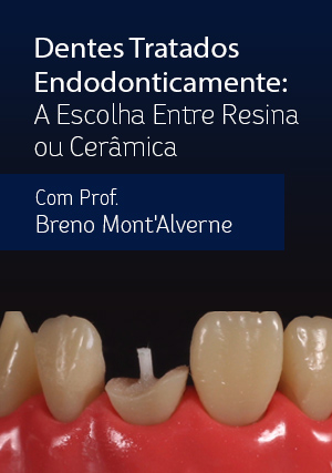 Cover for Dentes Tratados Endodonticamente: A Escolha Entre Resina ou Cerâmica