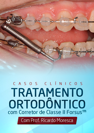Cover for Casos Clínicos - Tratamento Ortodôntico com Corretor de Classe II Forsus