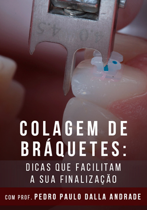 Cover for Colagem de Bráquetes: Dicas que Facilitam a sua Finalização