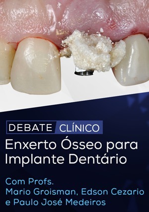 Cover for Debate Clínico: Enxerto Ósseo para Implante Dentário