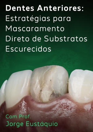 Cover for Dentes Anteriores: Estratégias para Mascaramento Direto de Substratos Escurecidos