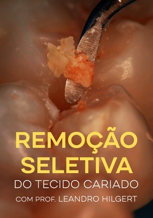 Cover for Remoção Seletiva do Tecido Cariado
