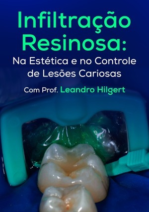Cover for Infiltração Resinosa: Na Estética e no Controle de Lesões Cariosas