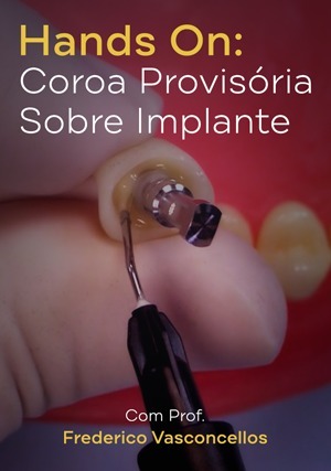 Cover for Hands On: Coroa Provisória Sobre Implante