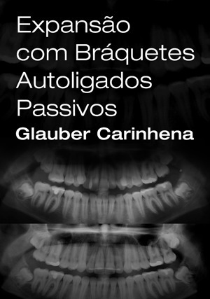 Cover for Expansão com Bráquetes Autoligados Passivos