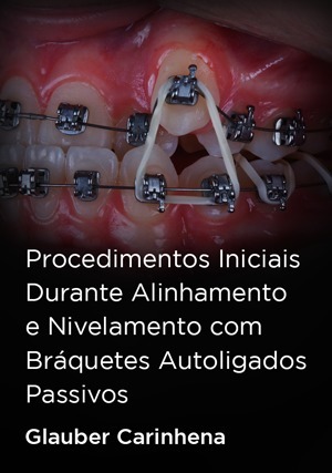 Cover for Procedimentos Iniciais Durante Alinhamento e Nivelamento com Bráquetes Autoligados Passivos