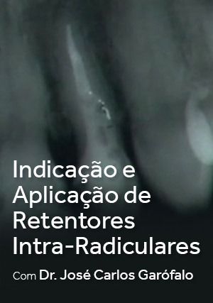 Cover for Indicação e aplicação de Retentores Intra-Radiculares
