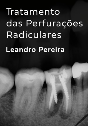 Cover for Tratamento das Perfurações Radiculares